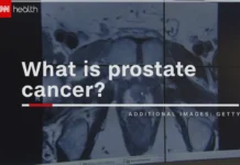 WATCH: What Is Prostate Cancer?