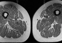 Ultraprocessed Foods Are Turning Human Thighs Into Well-Marbled Steaks