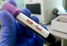 Study Examines Whether Dropping ESR Tests Actually Lowers Costs