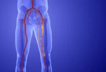 That Leg Pain May Not Be Aging. It Could Be PAD